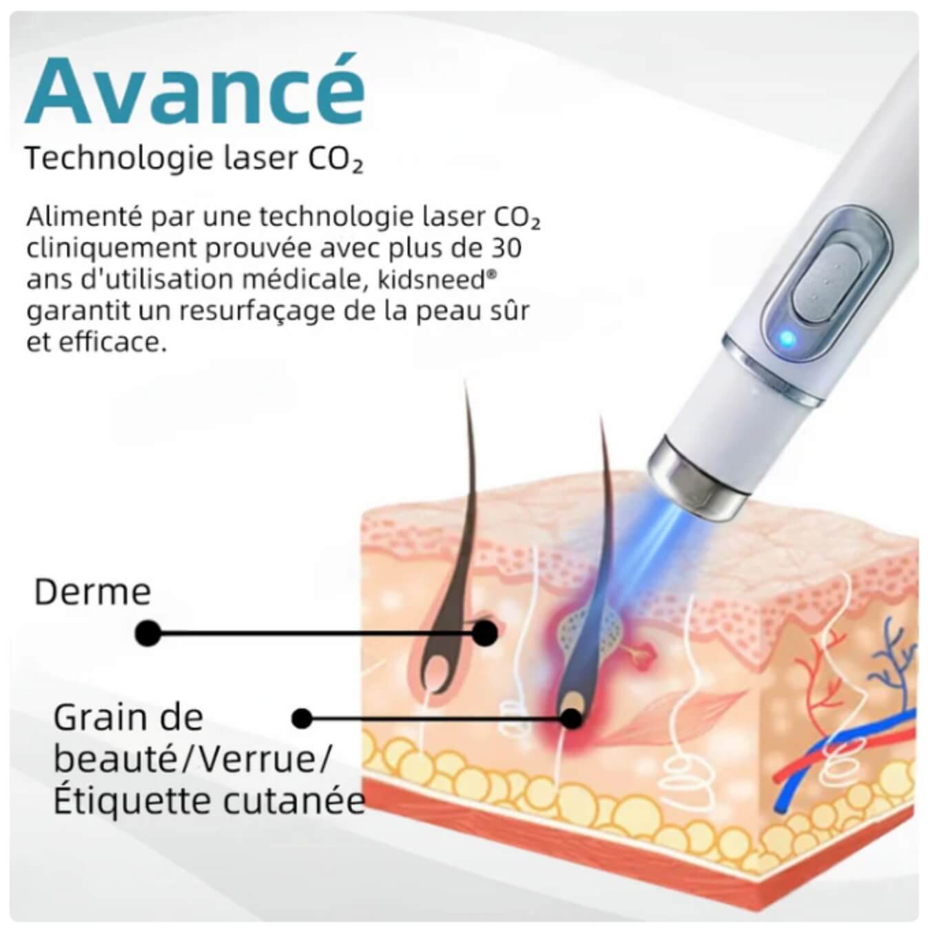 Kidsneed - Stylo Laser non invasif pour l'élimination des grains de beauté et des verrues