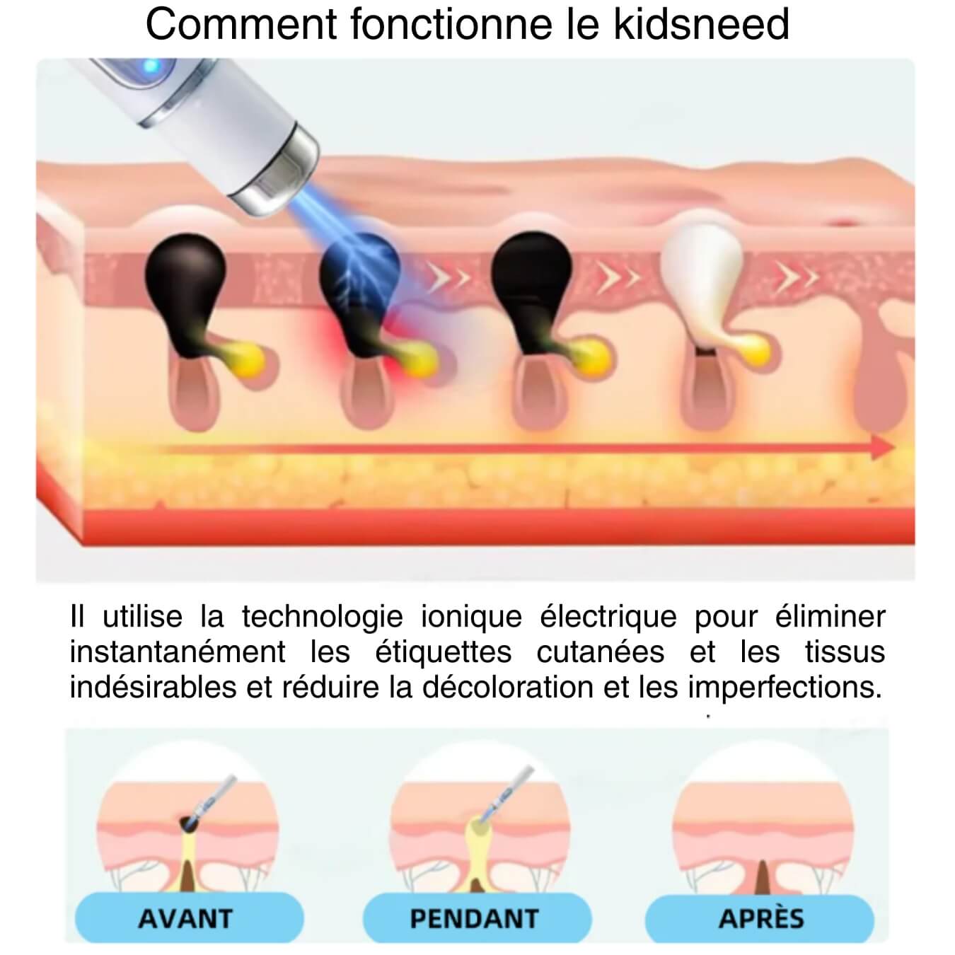 Kidsneed - Stylo Laser non invasif pour l'élimination des grains de beauté et des verrues