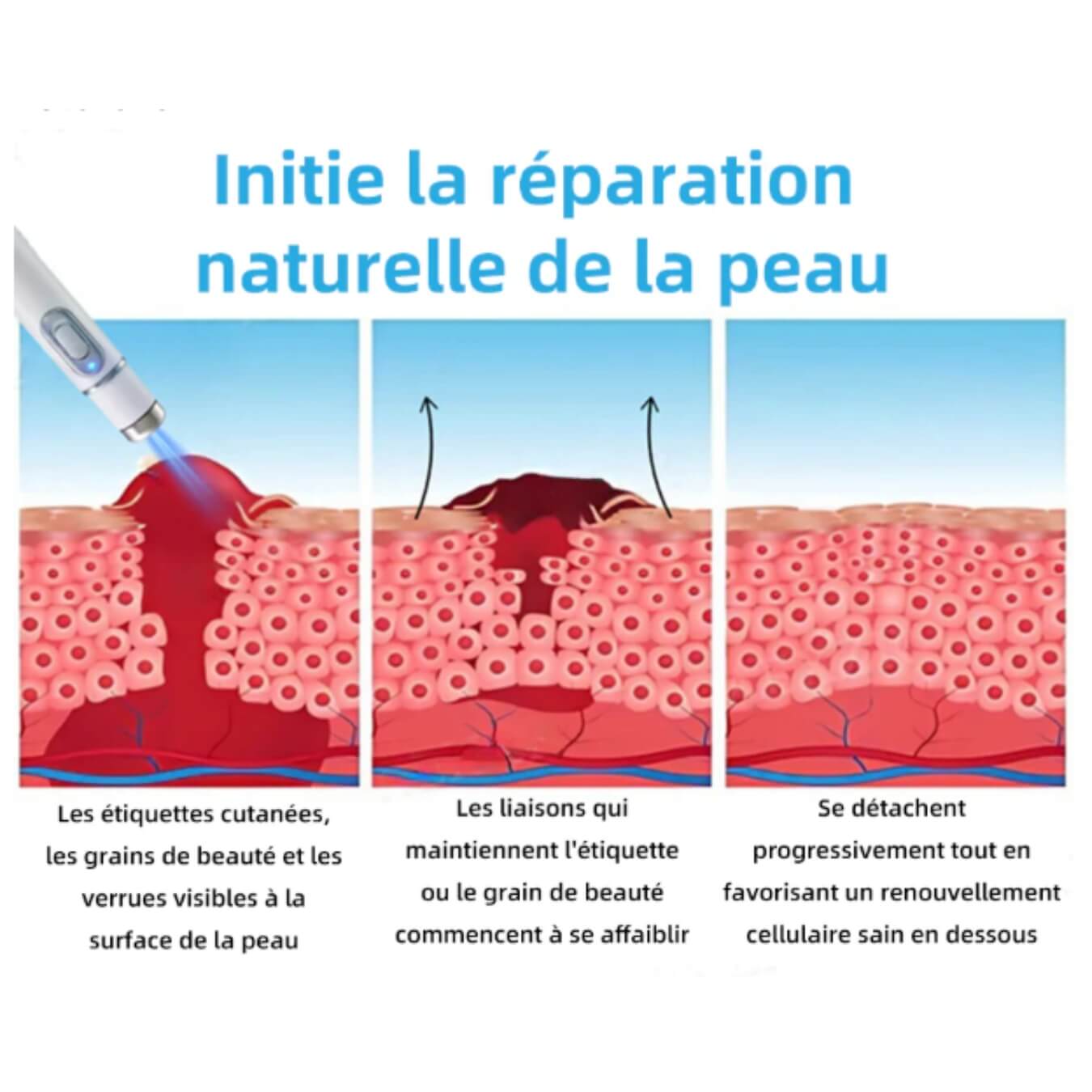 Kidsneed - Stylo Laser non invasif pour l'élimination des grains de beauté et des verrues